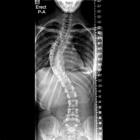 x ray for scoliosis